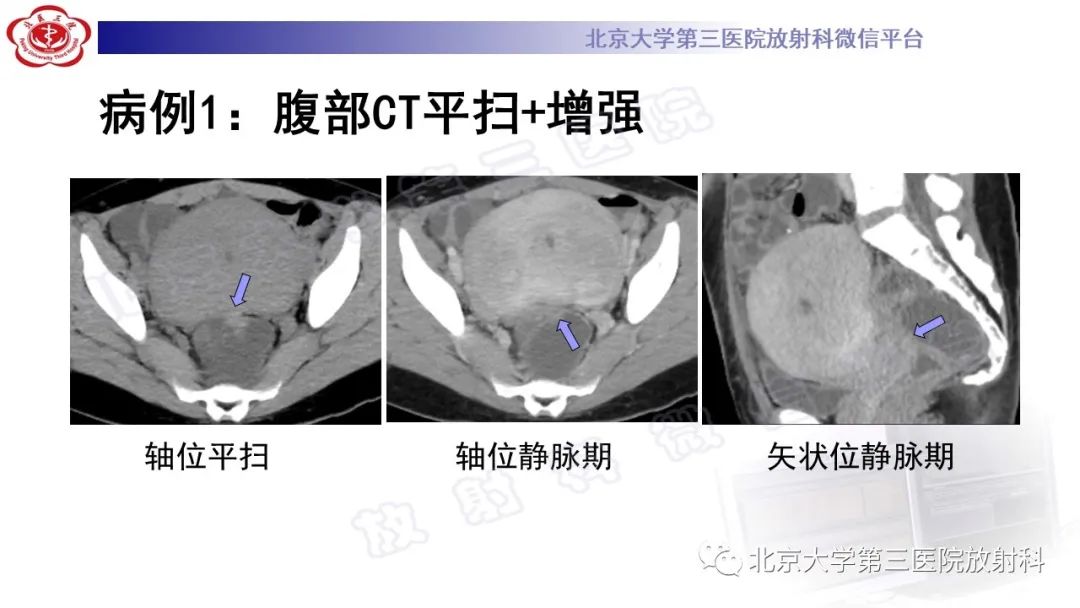 影像PPT - 【PPT】深部浸润型子宫内膜异位症-4
