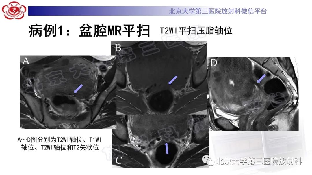 影像PPT - 【PPT】深部浸润型子宫内膜异位症-3