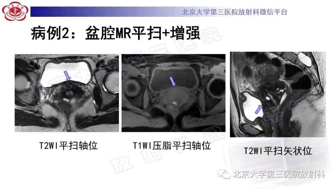 影像PPT - 【PPT】深部浸润型子宫内膜异位症-5