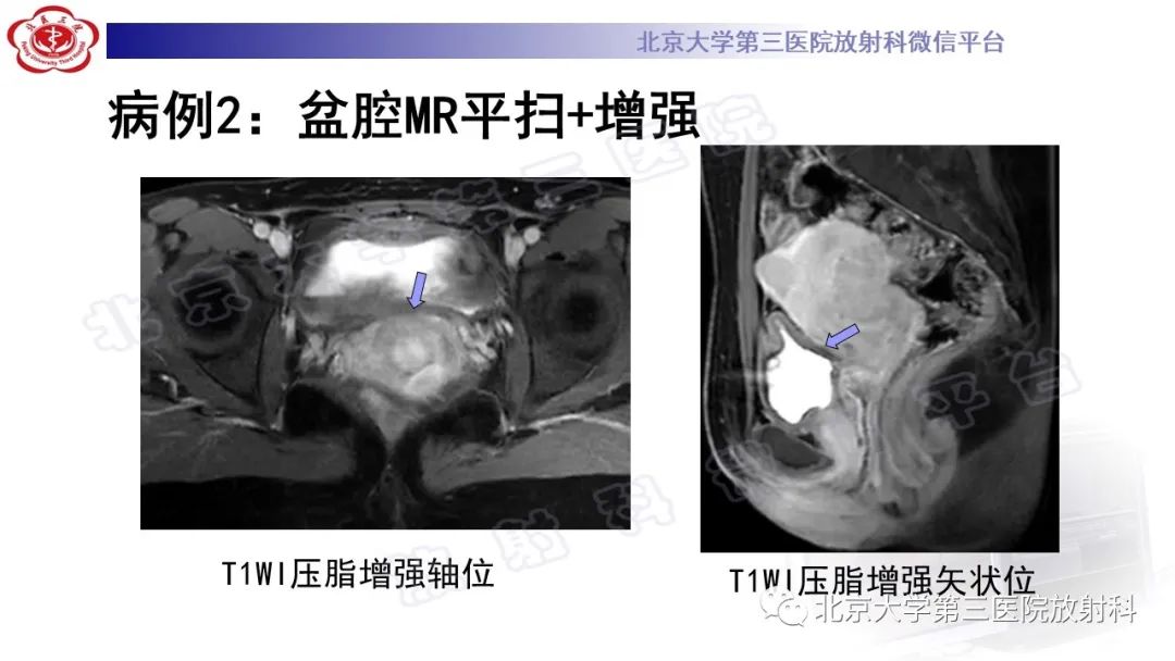 影像PPT - 【PPT】深部浸润型子宫内膜异位症-6