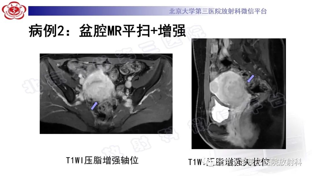 影像PPT - 【PPT】深部浸润型子宫内膜异位症-7