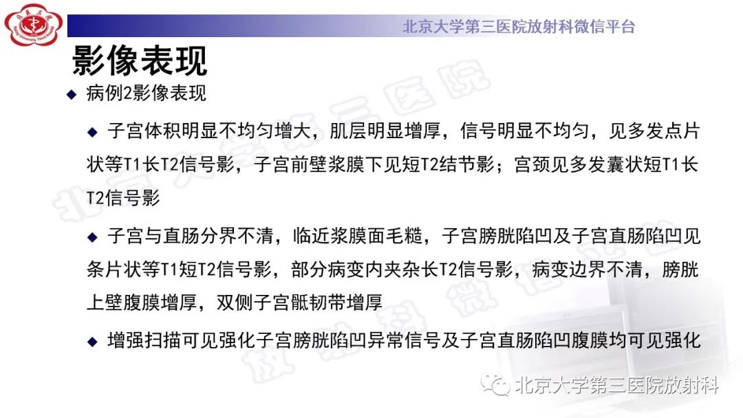 影像PPT - 【PPT】深部浸润型子宫内膜异位症-9
