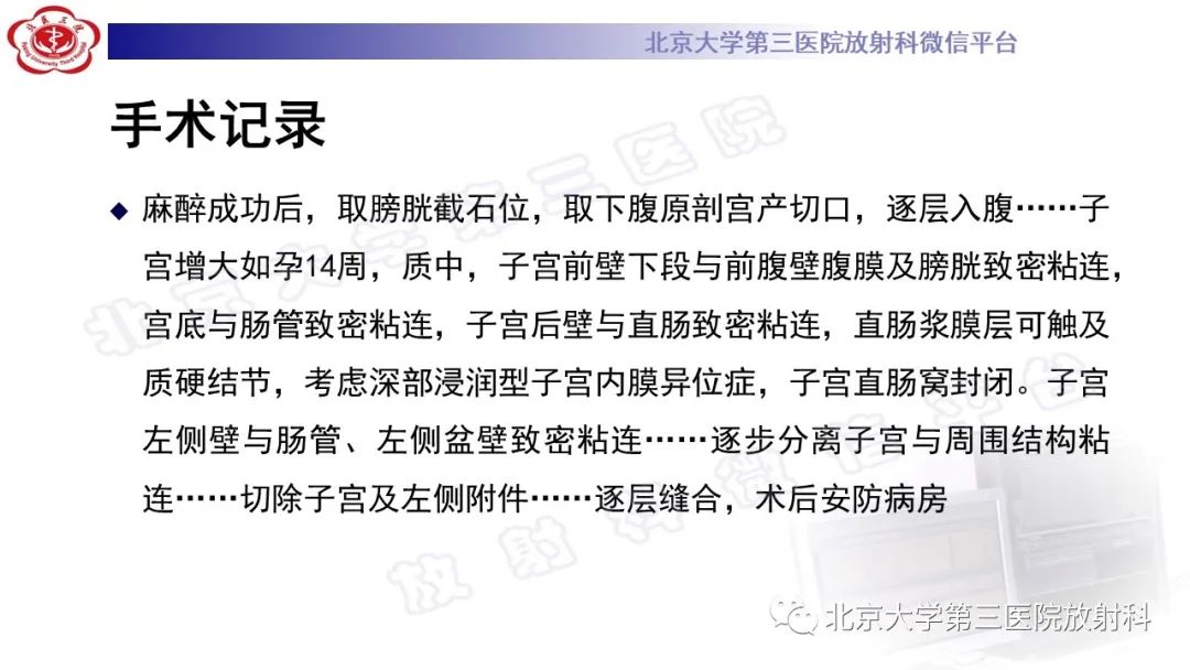 影像PPT - 【PPT】深部浸润型子宫内膜异位症-10
