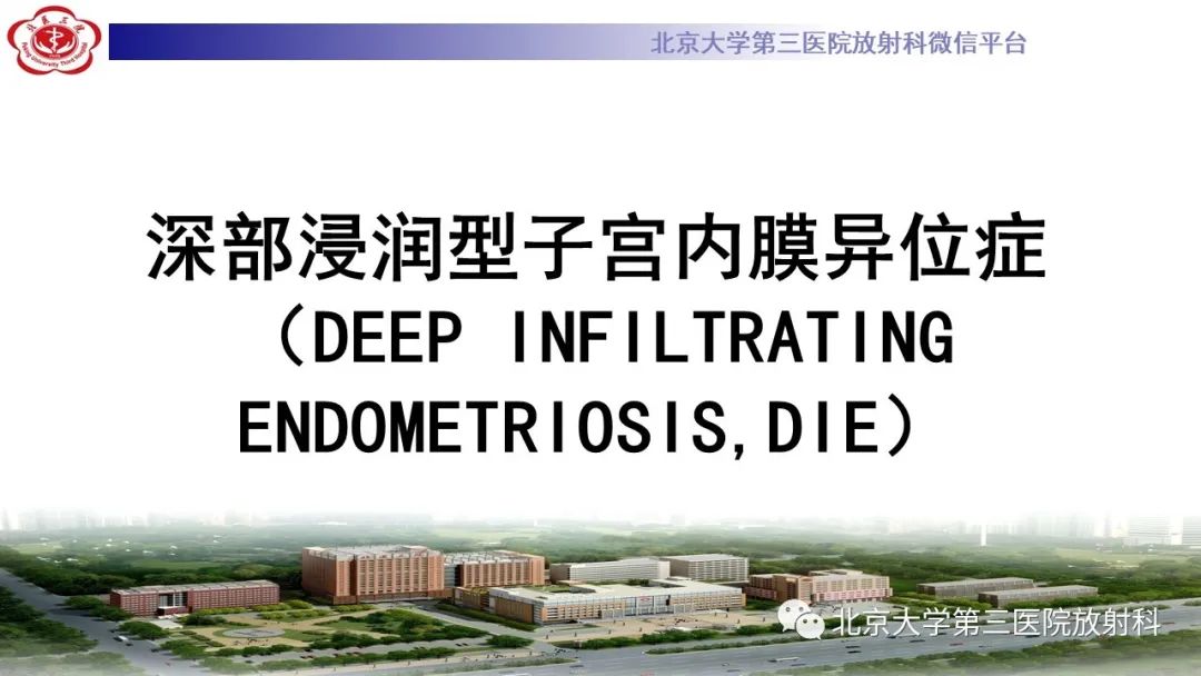 影像PPT - 【PPT】深部浸润型子宫内膜异位症-12