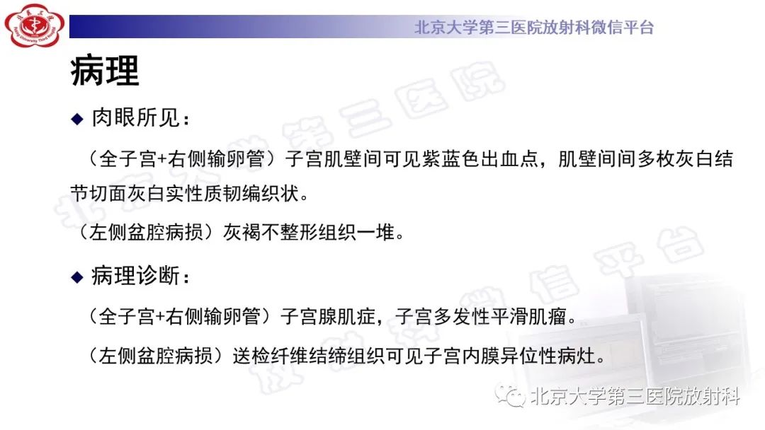 影像PPT - 【PPT】深部浸润型子宫内膜异位症-11
