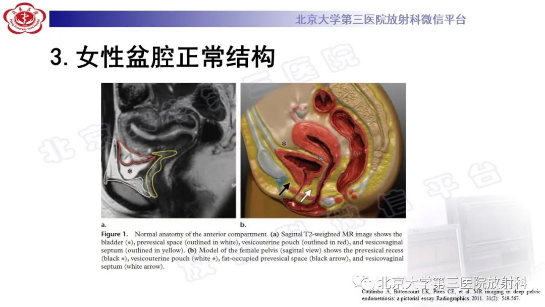 影像PPT - 【PPT】深部浸润型子宫内膜异位症-17
