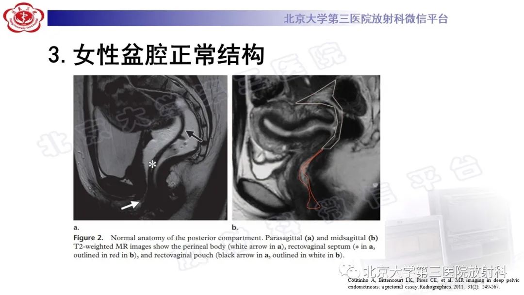影像PPT - 【PPT】深部浸润型子宫内膜异位症-18