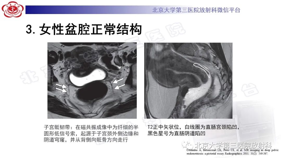 影像PPT - 【PPT】深部浸润型子宫内膜异位症-19