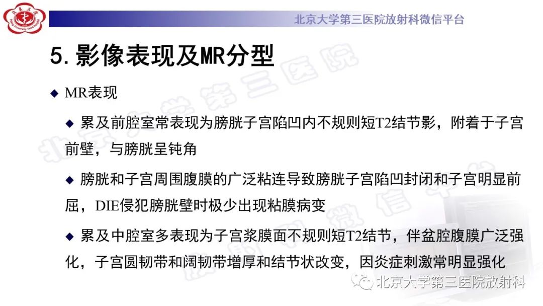 影像PPT - 【PPT】深部浸润型子宫内膜异位症-21