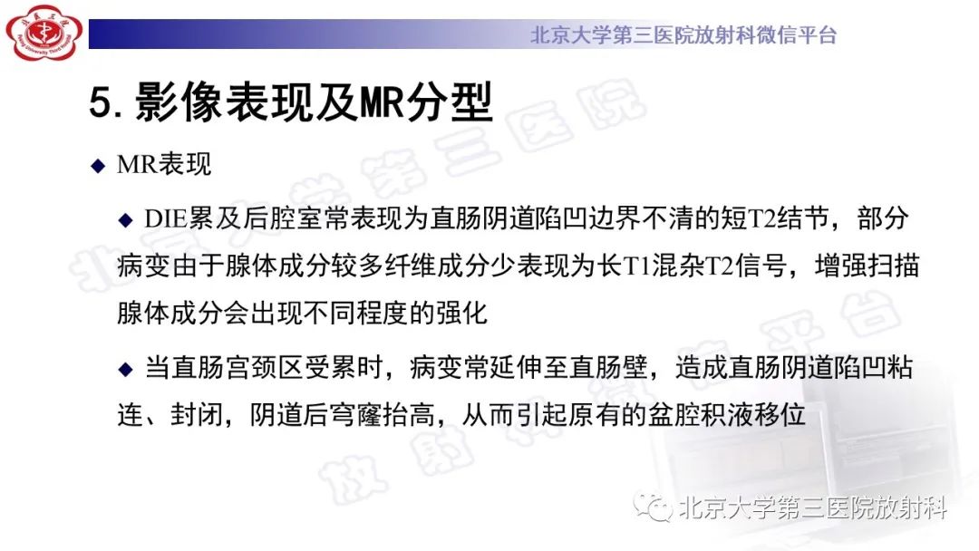 影像PPT - 【PPT】深部浸润型子宫内膜异位症-22