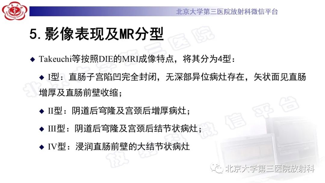影像PPT - 【PPT】深部浸润型子宫内膜异位症-23