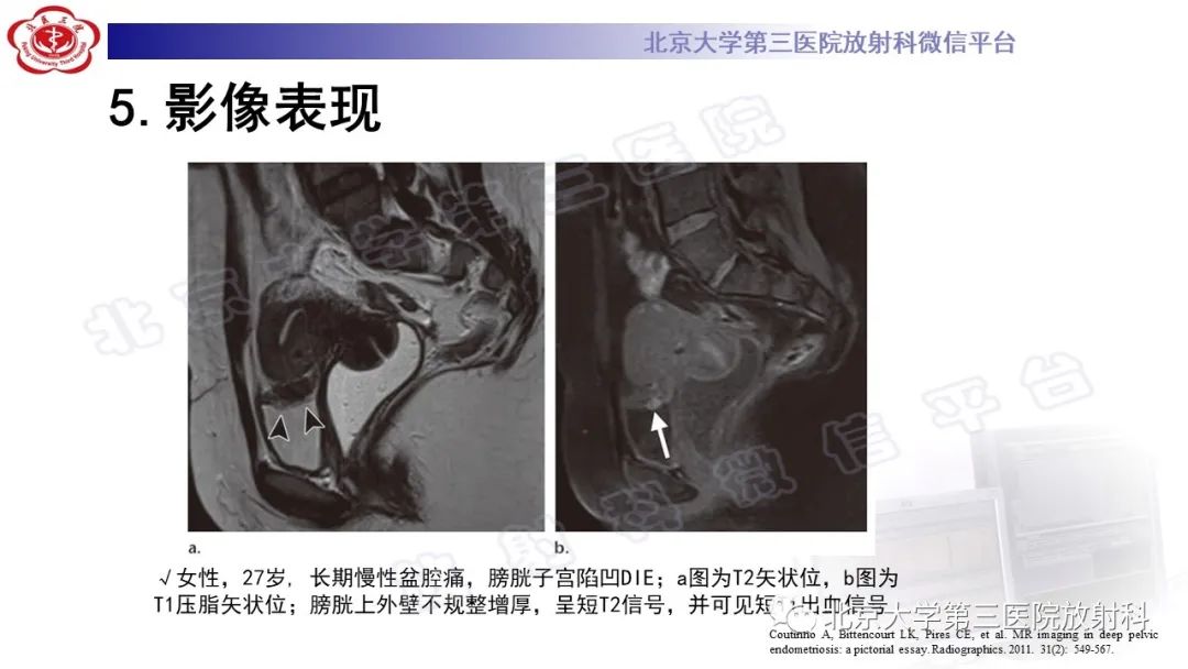 影像PPT - 【PPT】深部浸润型子宫内膜异位症-24