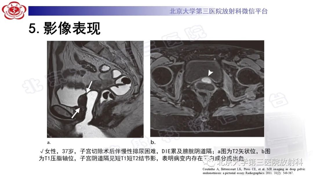 影像PPT - 【PPT】深部浸润型子宫内膜异位症-25