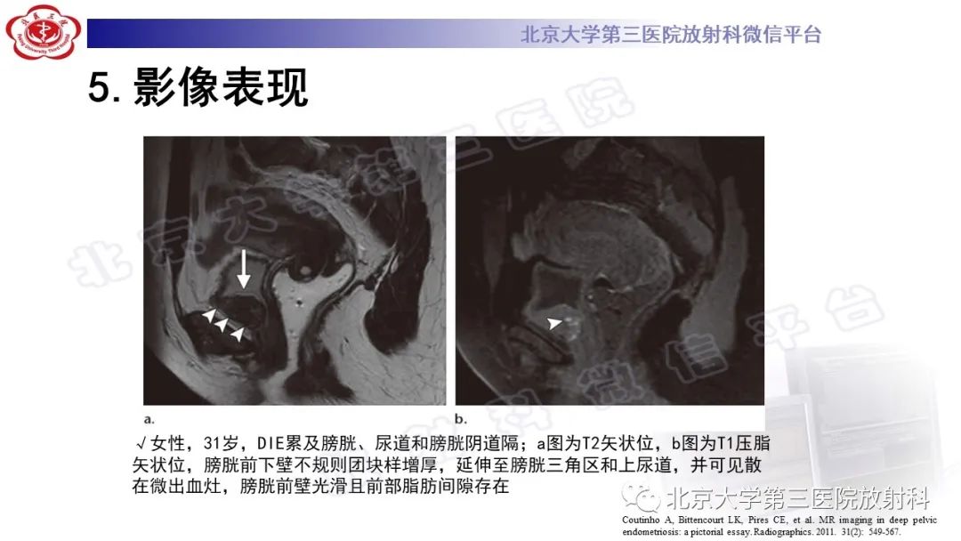 影像PPT - 【PPT】深部浸润型子宫内膜异位症-26
