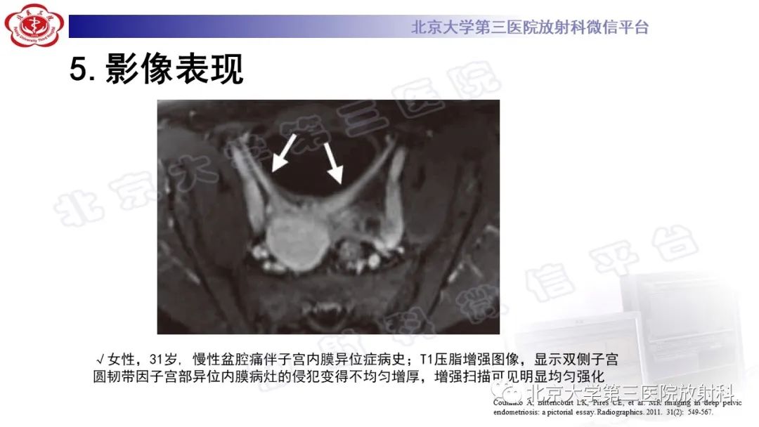 影像PPT - 【PPT】深部浸润型子宫内膜异位症-27