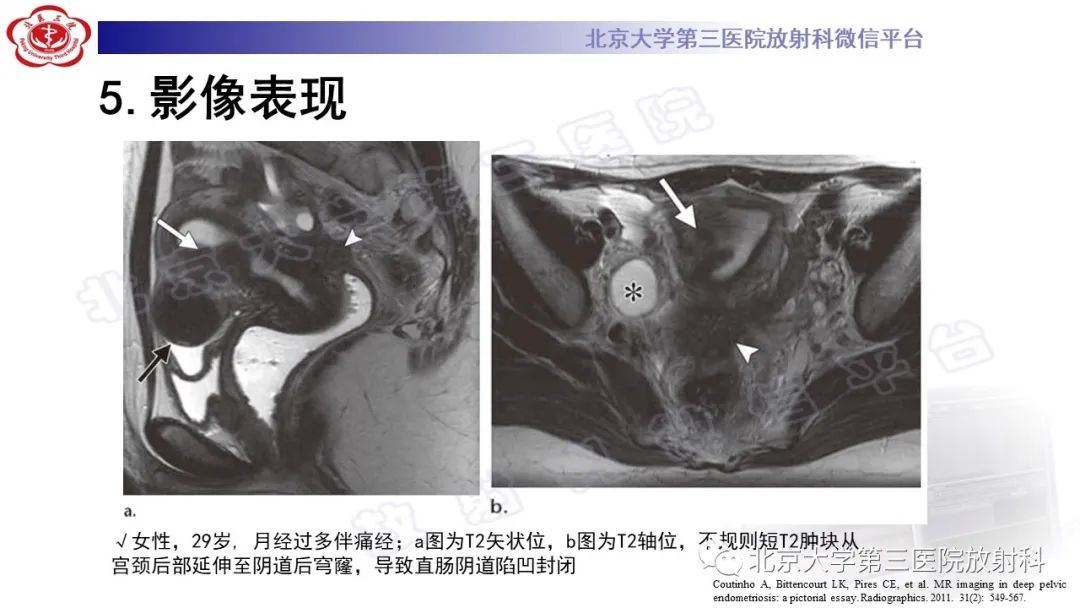 影像PPT - 【PPT】深部浸润型子宫内膜异位症-28