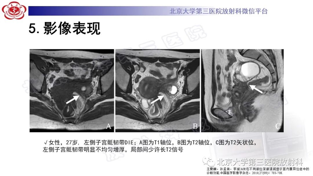 影像PPT - 【PPT】深部浸润型子宫内膜异位症-29