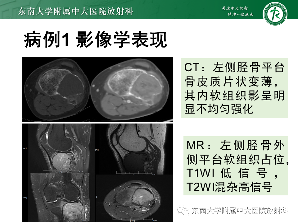 影像PPT - 【PPT】骨巨细胞瘤-3