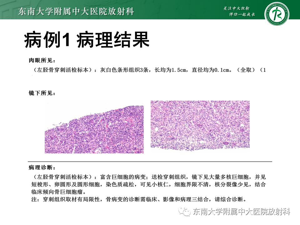 影像PPT - 【PPT】骨巨细胞瘤-4
