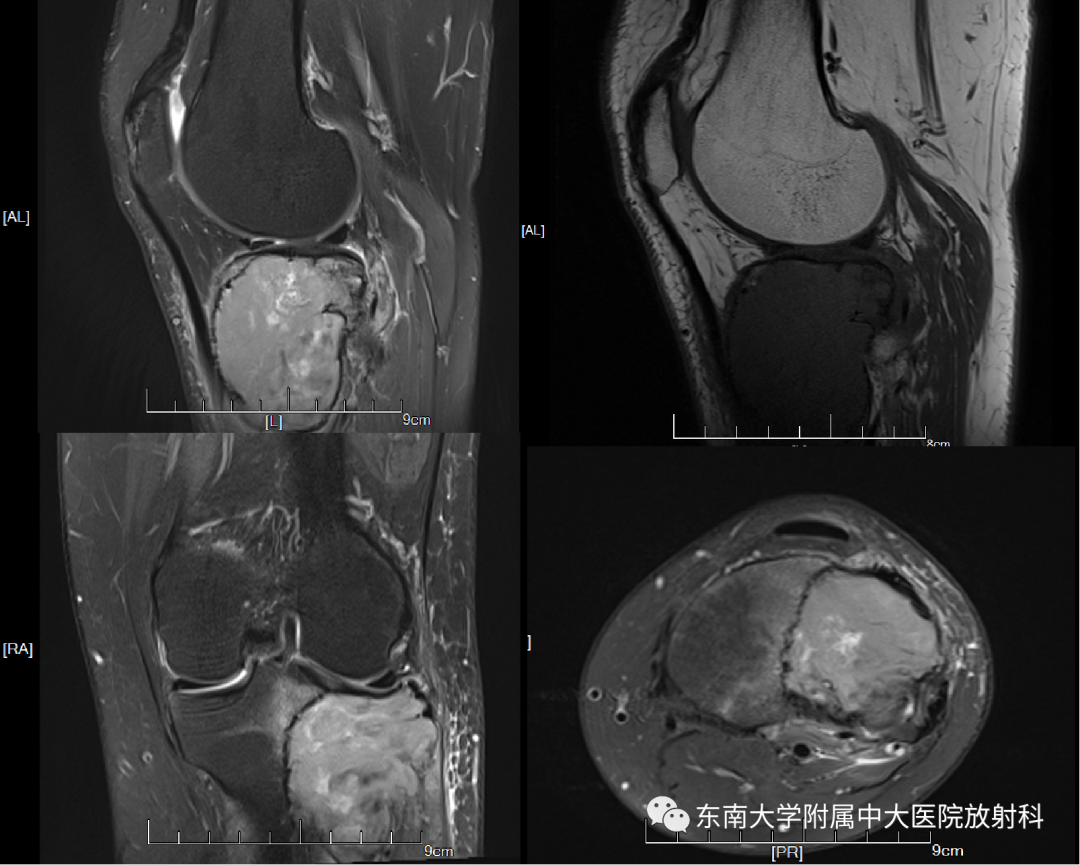 影像PPT - 【PPT】骨巨细胞瘤-2
