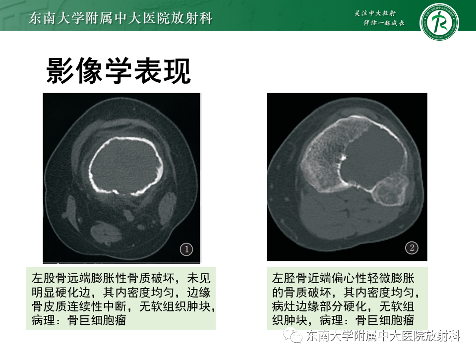 影像PPT - 【PPT】骨巨细胞瘤-12