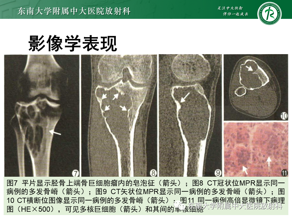 影像PPT - 【PPT】骨巨细胞瘤-13