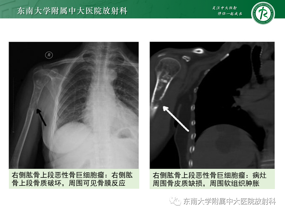影像PPT - 【PPT】骨巨细胞瘤-16