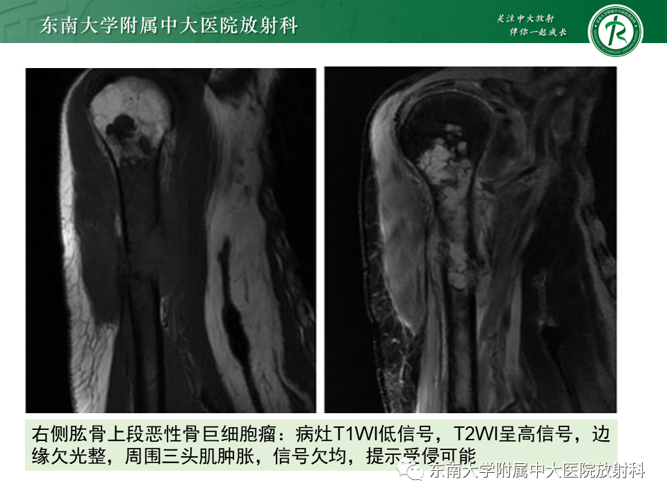 影像PPT - 【PPT】骨巨细胞瘤-17
