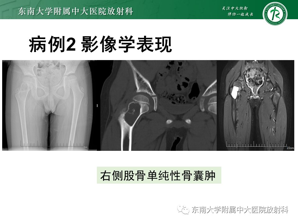 影像PPT - 【PPT】骨巨细胞瘤-21
