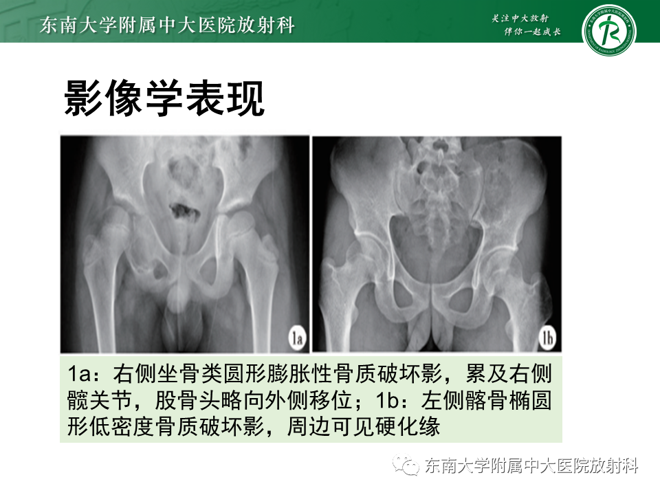 影像PPT - 【PPT】骨巨细胞瘤-23