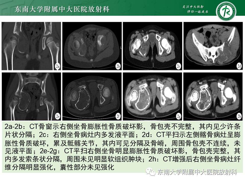 影像PPT - 【PPT】骨巨细胞瘤-24