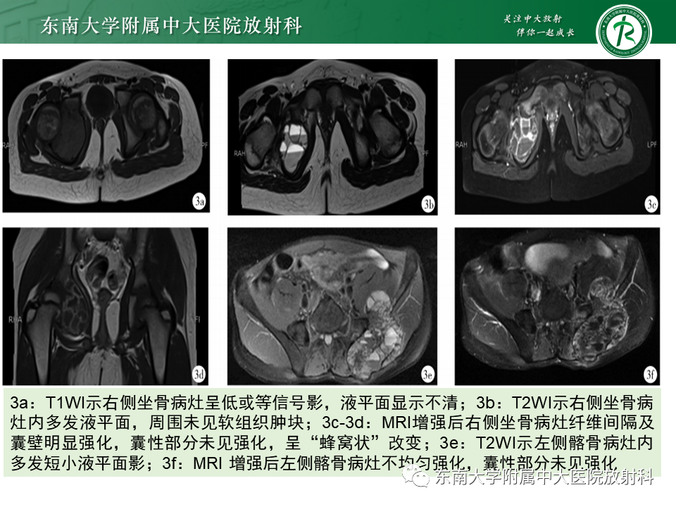 影像PPT - 【PPT】骨巨细胞瘤-25