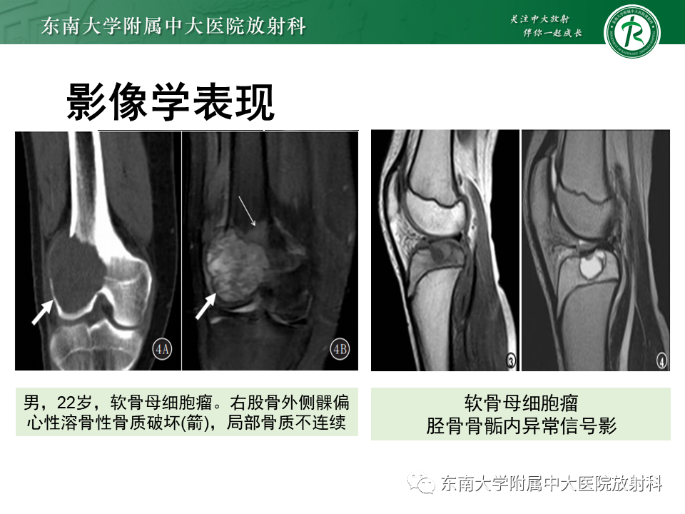 影像PPT - 【PPT】骨巨细胞瘤-27