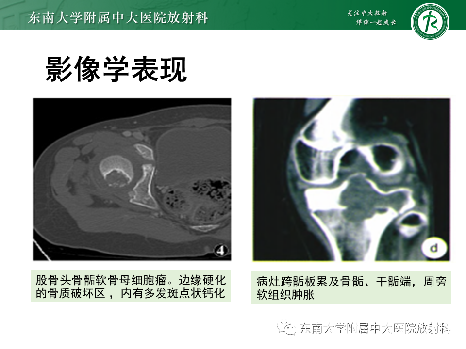 影像PPT - 【PPT】骨巨细胞瘤-28