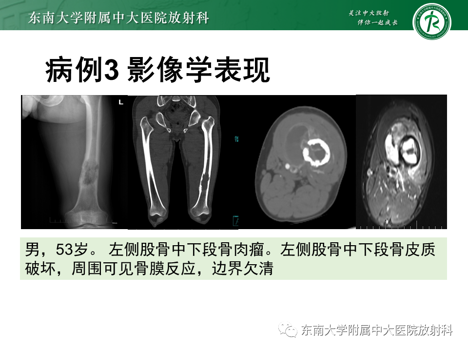 影像PPT - 【PPT】骨巨细胞瘤-31