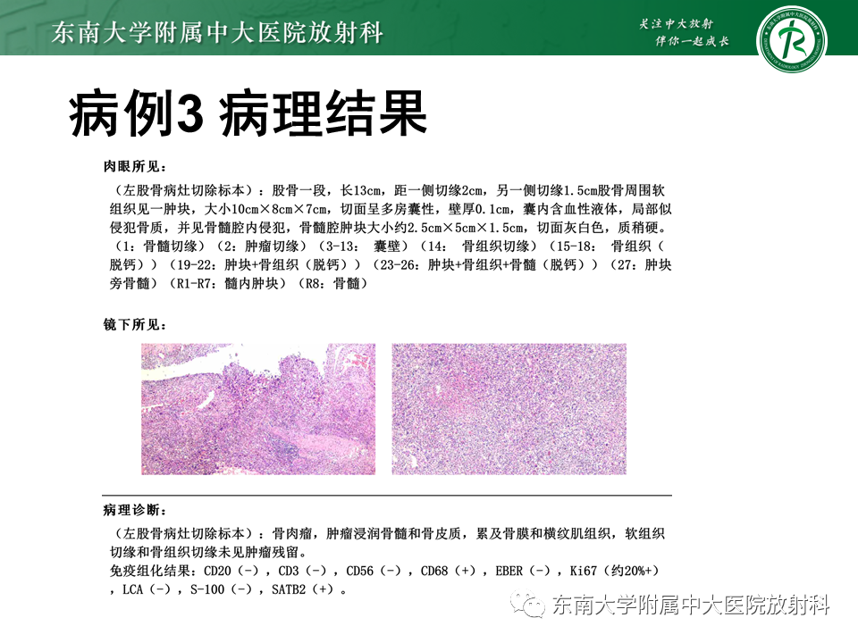 影像PPT - 【PPT】骨巨细胞瘤-32