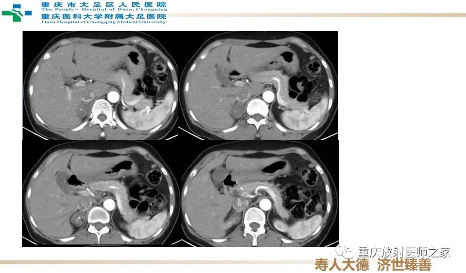 影像PPT - 【病例】肾上腺血管瘤1例CT影像-3