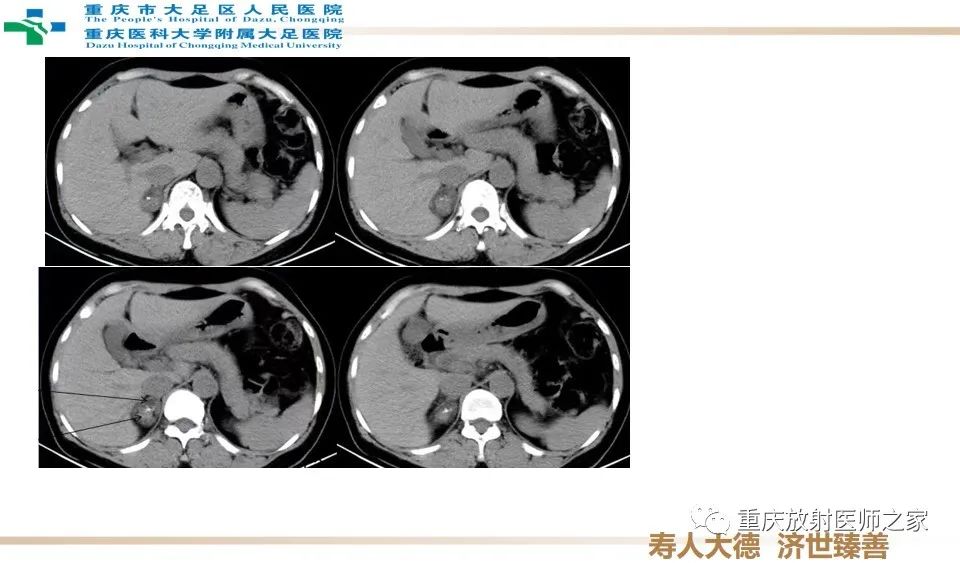 影像PPT - 【病例】肾上腺血管瘤1例CT影像-2