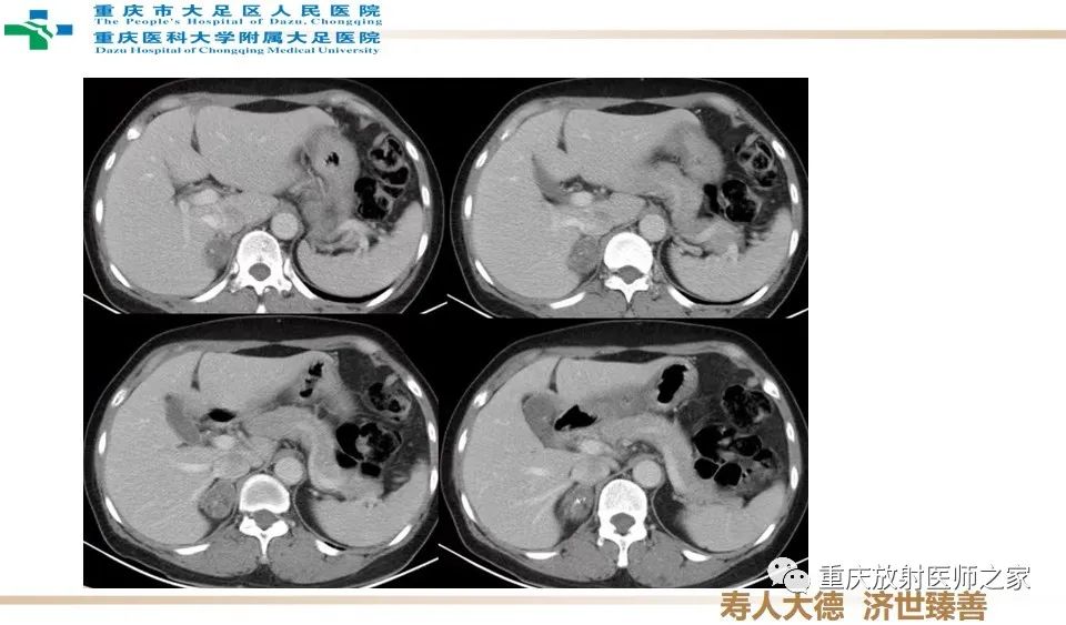影像PPT - 【病例】肾上腺血管瘤1例CT影像-4