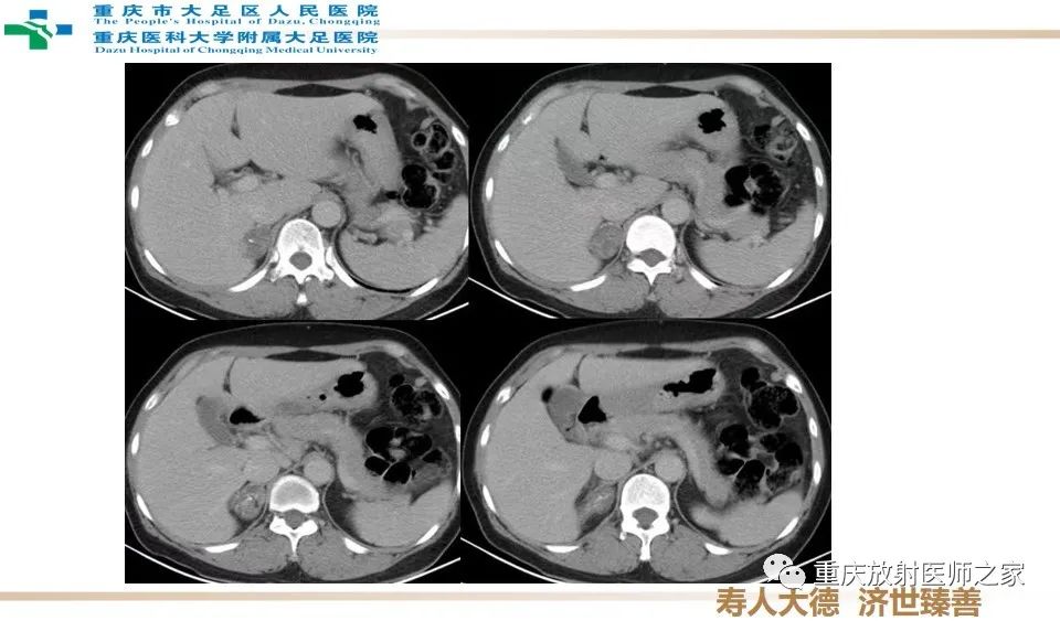 影像PPT - 【病例】肾上腺血管瘤1例CT影像-5