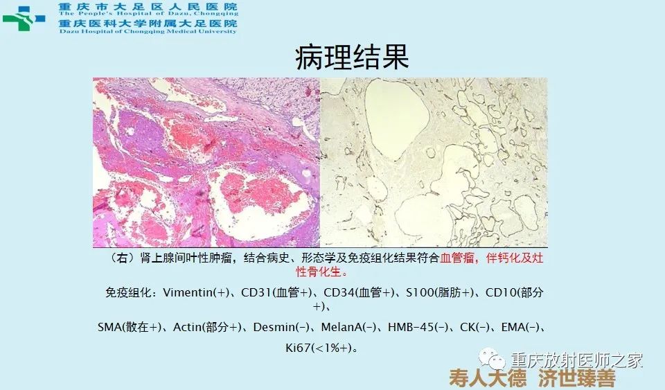 影像PPT - 【病例】肾上腺血管瘤1例CT影像-6