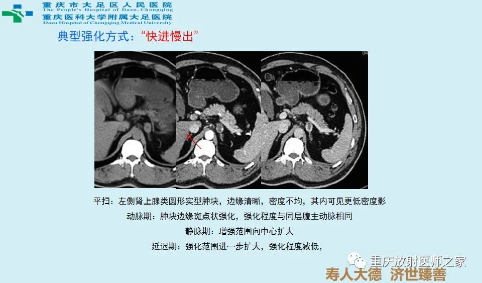 影像PPT - 【病例】肾上腺血管瘤1例CT影像-9