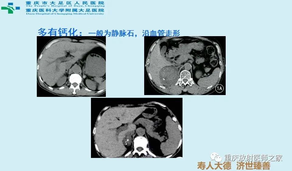 影像PPT - 【病例】肾上腺血管瘤1例CT影像-8