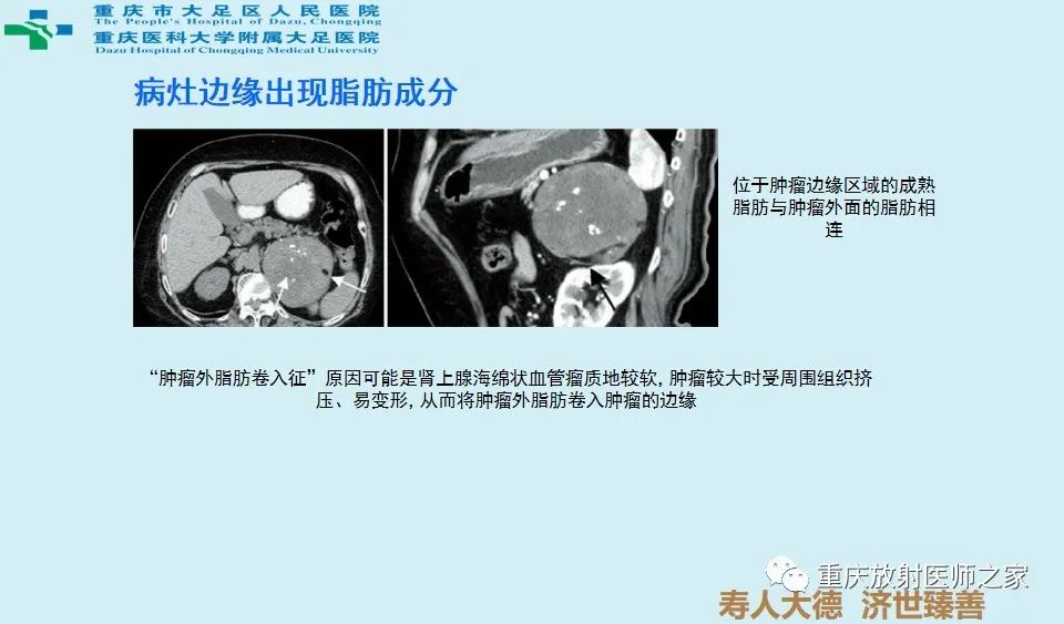 影像PPT - 【病例】肾上腺血管瘤1例CT影像-10