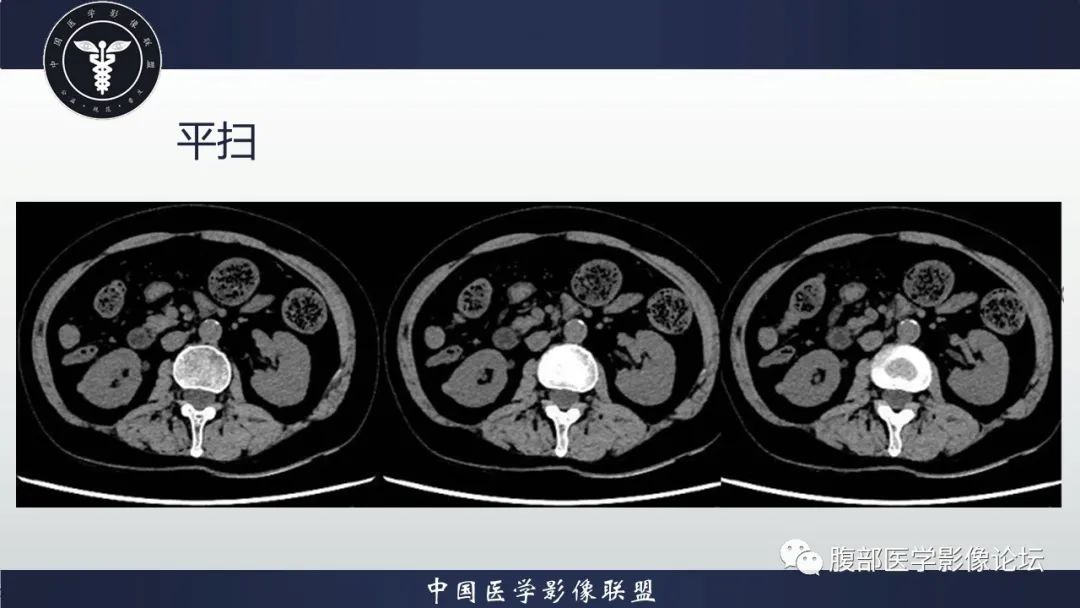 影像PPT - 【病例】肾脏嗜酸细胞腺瘤-2