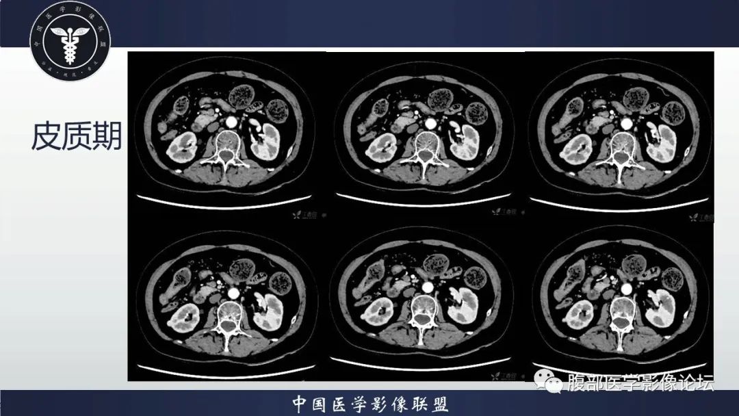 影像PPT - 【病例】肾脏嗜酸细胞腺瘤-3