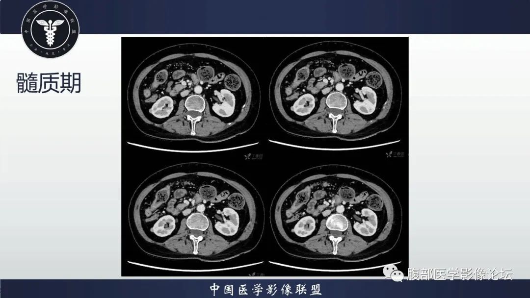 影像PPT - 【病例】肾脏嗜酸细胞腺瘤-4