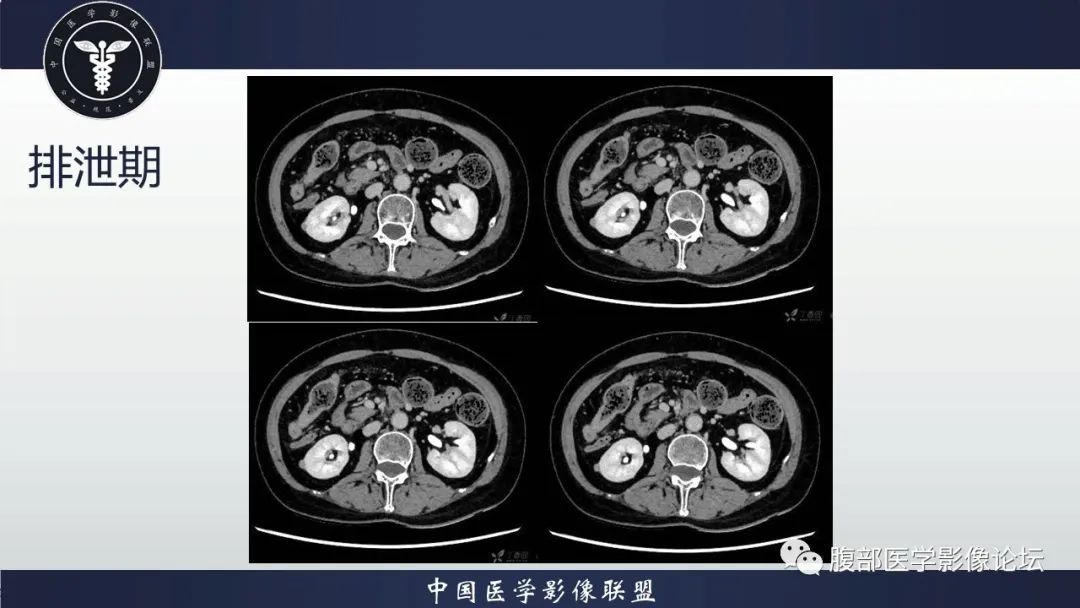 影像PPT - 【病例】肾脏嗜酸细胞腺瘤-5