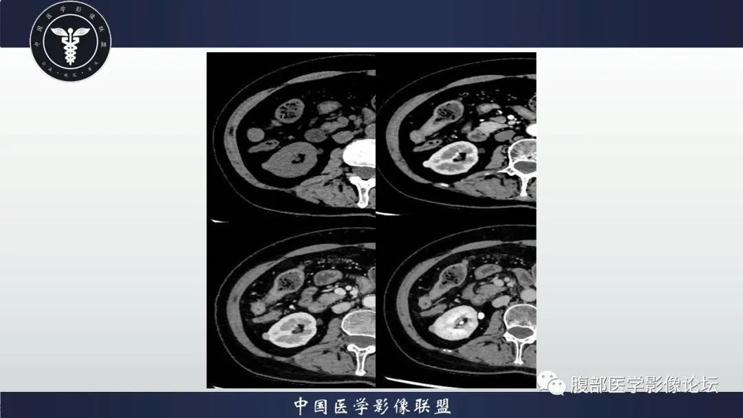 影像PPT - 【病例】肾脏嗜酸细胞腺瘤-6