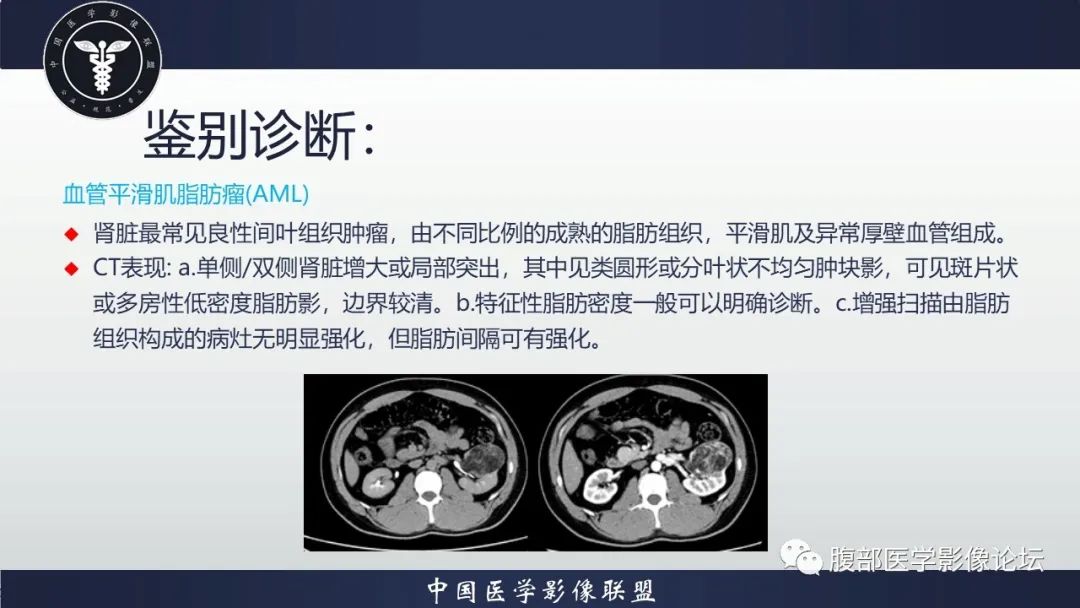 影像PPT - 【病例】肾脏嗜酸细胞腺瘤-10